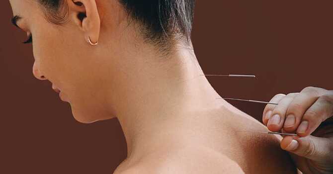 The History And Science Of Acupuncture image