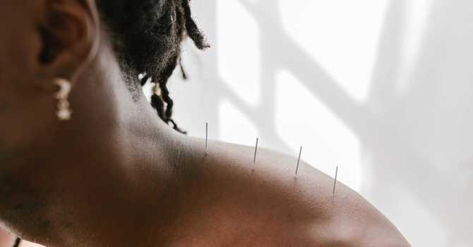 How Can Acupuncture Help with Chronic Pain? image