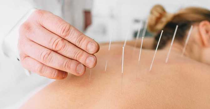 The 5 Known Benefits Of Acupuncture Treatment